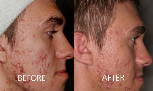 Acne Treatment laser skin treatment Vitality Medi-Spa Halifax NS